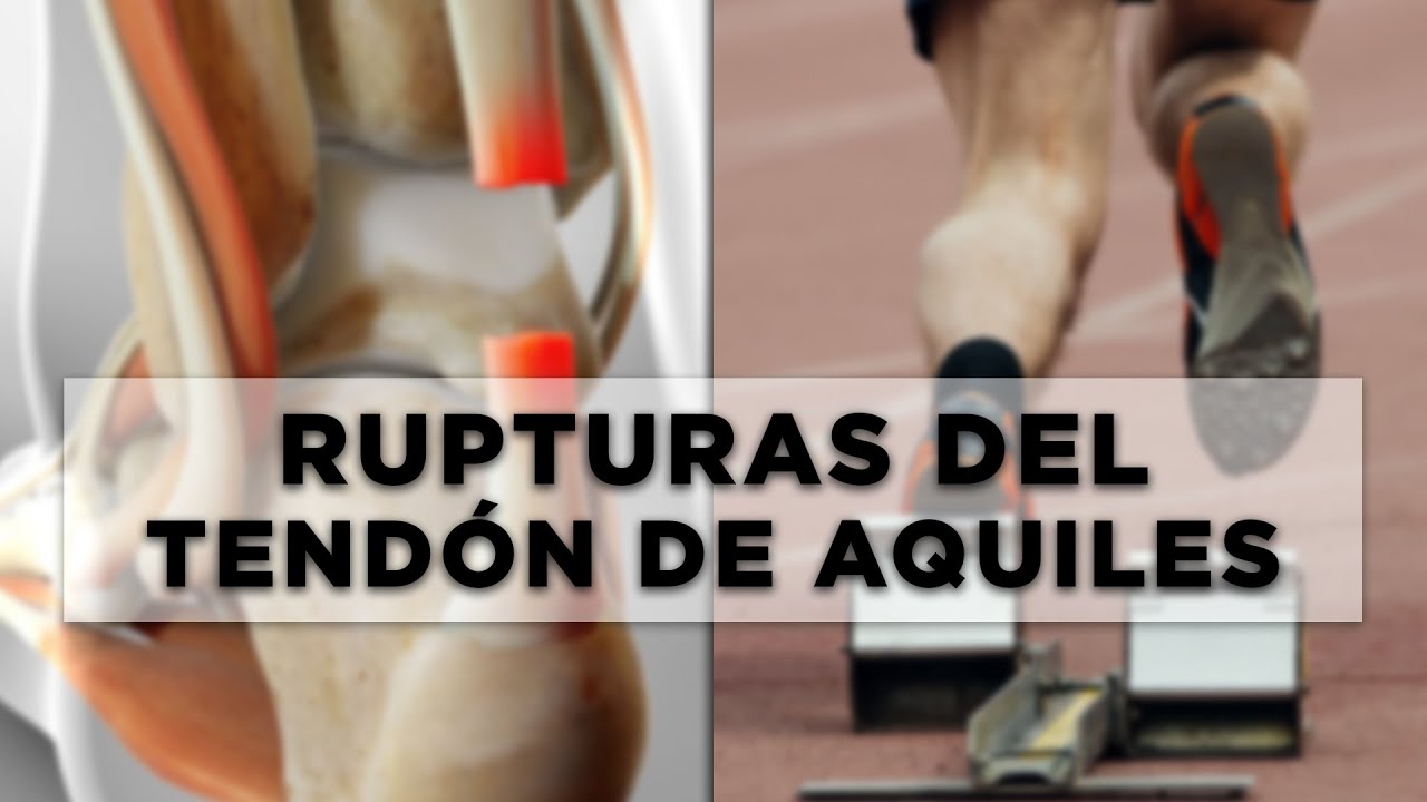 Rupturas del tendón de Aquiles: Lo que deberías de saber.