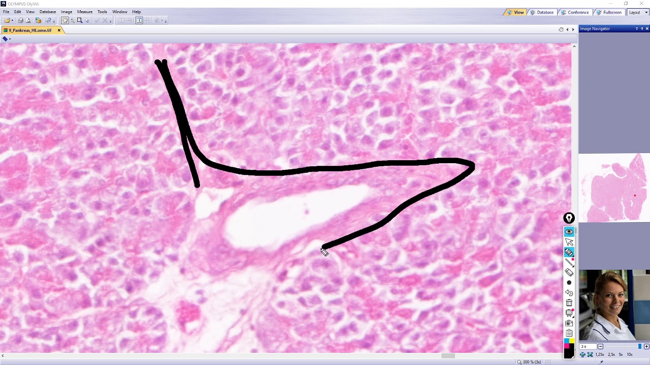 pancreas (slinivka břišní)