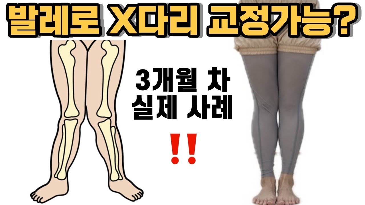 초중급ㅣ발레로 예쁜다리🩵만들자 2편ㅣX다리교정운동🩰 외회전형 내회전형 엑스다리 운동ㅣ다리교정 휜다리 교정발레 취미발레 하체비만 일자다리