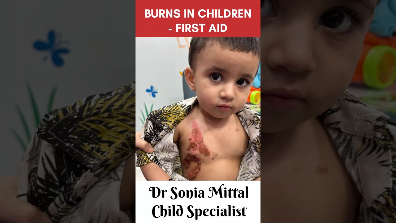 BURNS IN CHILDREN- FIRST AID 