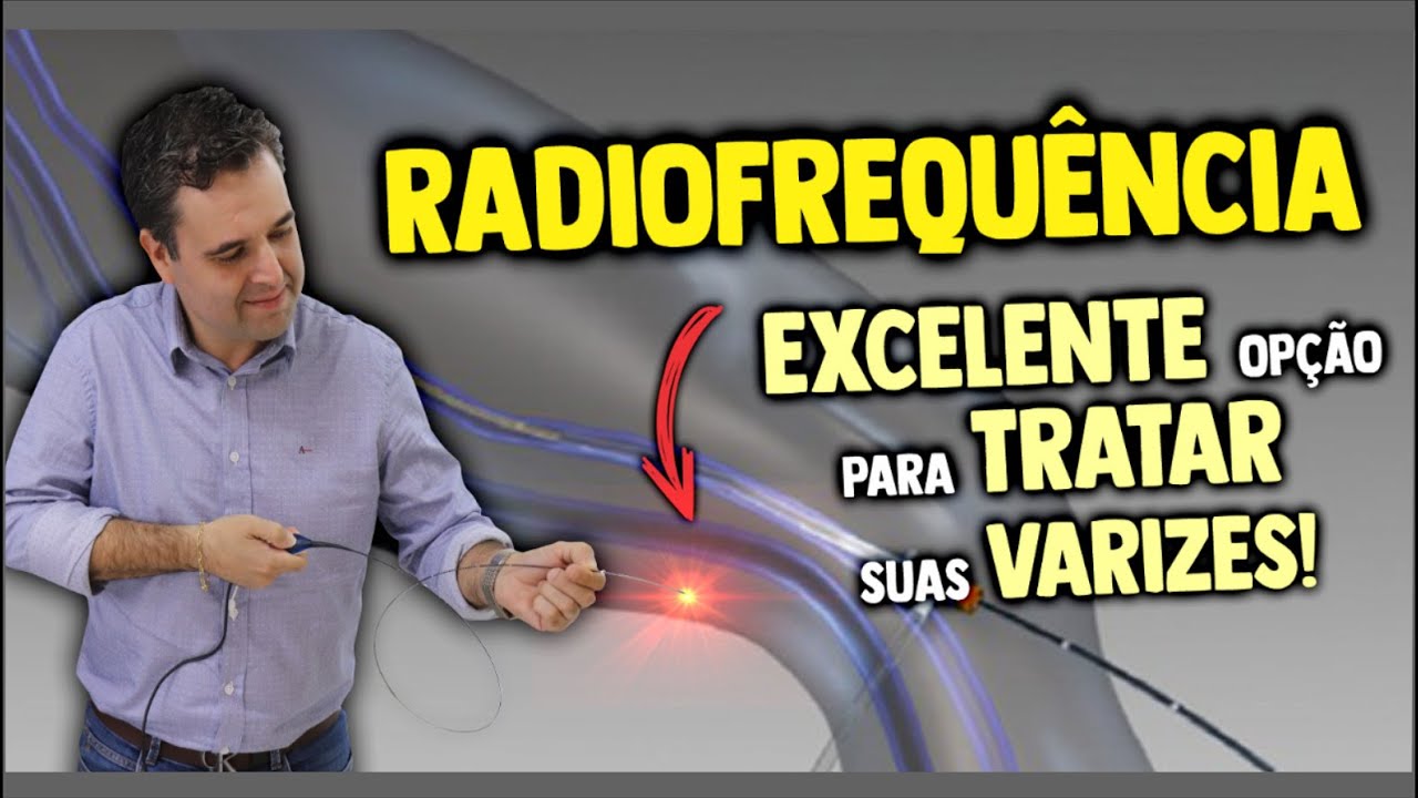 RADIOFREQU&Ecirc;NCIA | EXCELENTE OP&Ccedil;&Atilde;O PARA TRATAR SUAS VARIZES