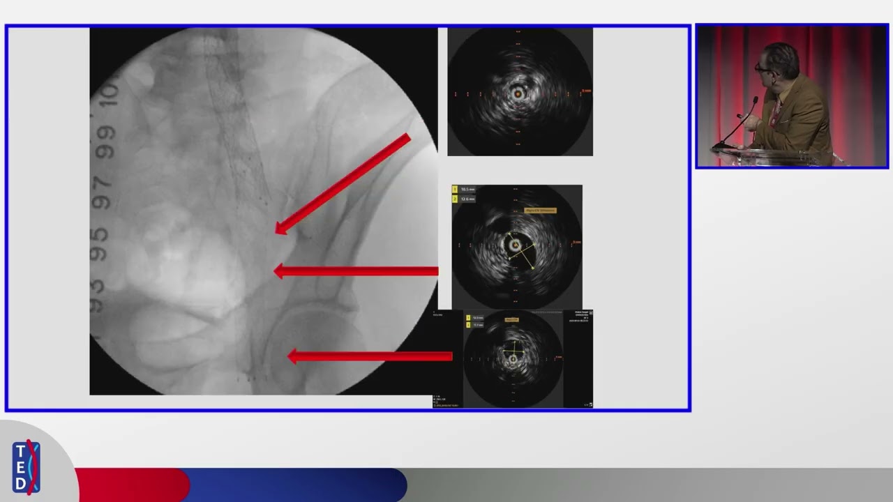 Pearls of Wisdom on Iliac Venous Stenting | Dr. Mohsen Sharifi at TED 2025