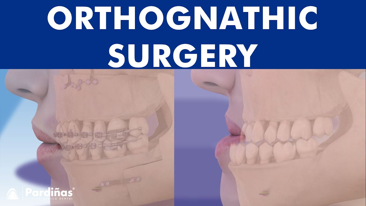 ORTHOGNATHIC surgery - All about JAW realignment surgery ©