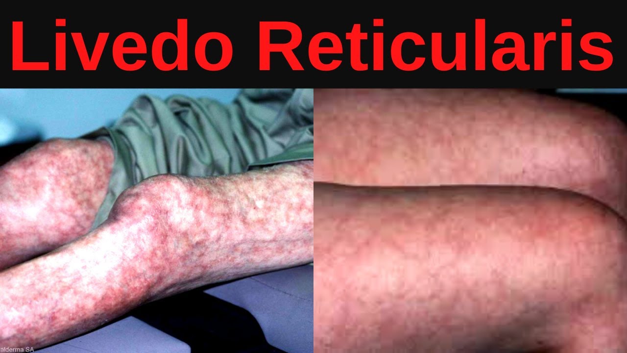 What is Livedo Reticularis? Causes, Treatment