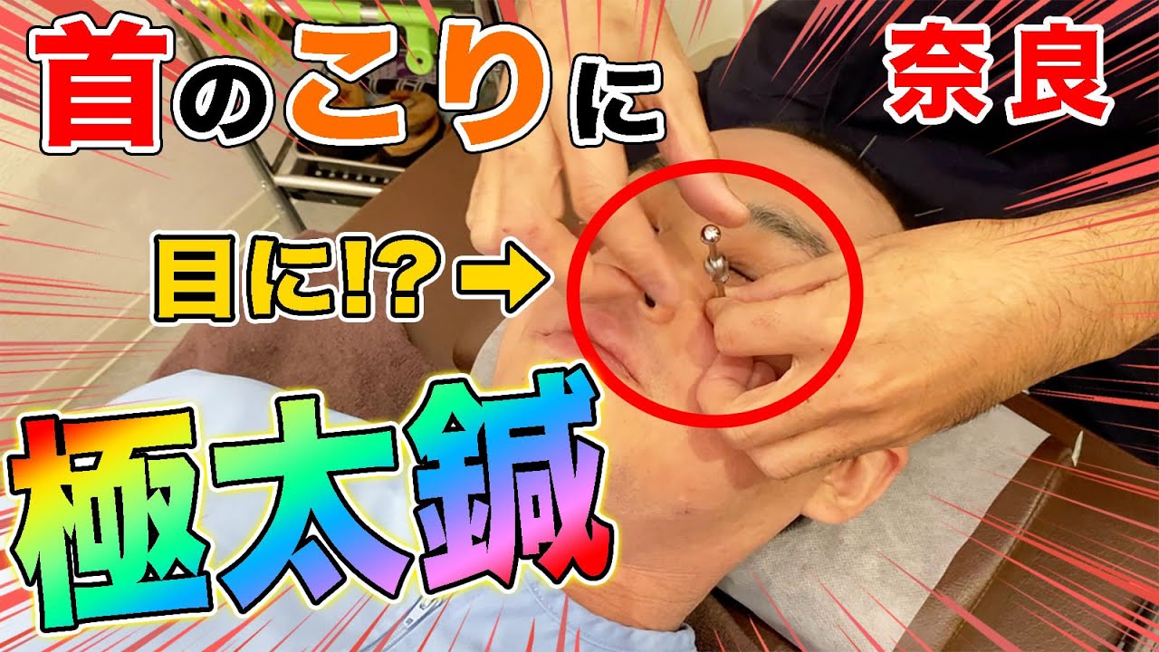 【首こり】極太鍼を目に！？首がガッチガチな40代男性に鍼治療！【えにし堂鍼灸整骨院】