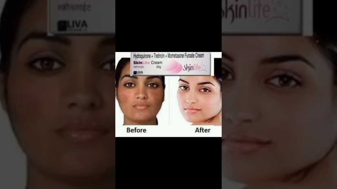 skinlite cream review and my experience with skinlite cream @kosjayrafamily96