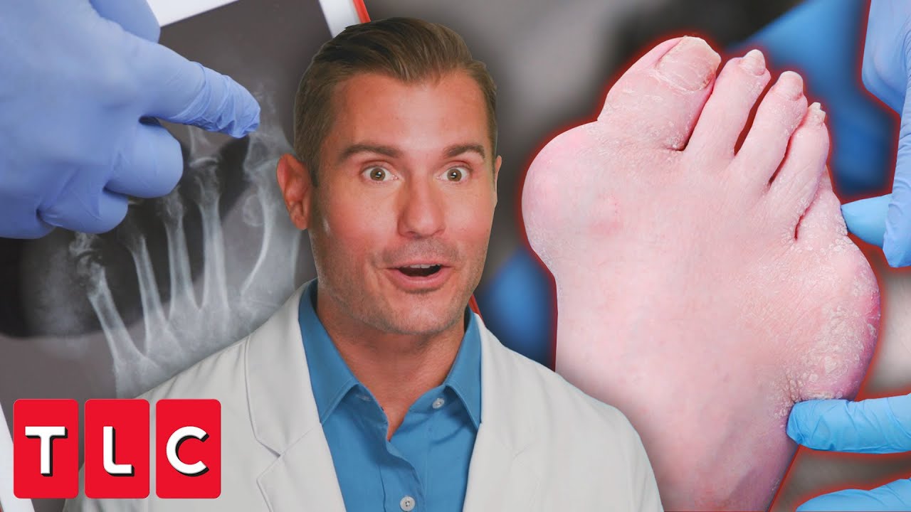 Hammerhead Foot? Dr. Brad Treats Severe Gout | My Feet Are Killing Me