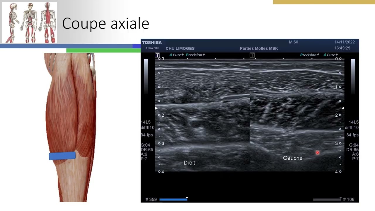 Séquelle de Tennis Leg (désinsertion myoaponévrotique du gastrocnémien médial sur le soléaire)
