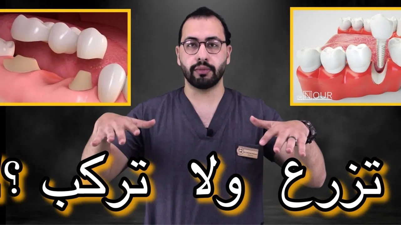 زراعة ولا تركيبة  أفضل؟مقارنة فيها الجواب النهائى اللى هيريحك