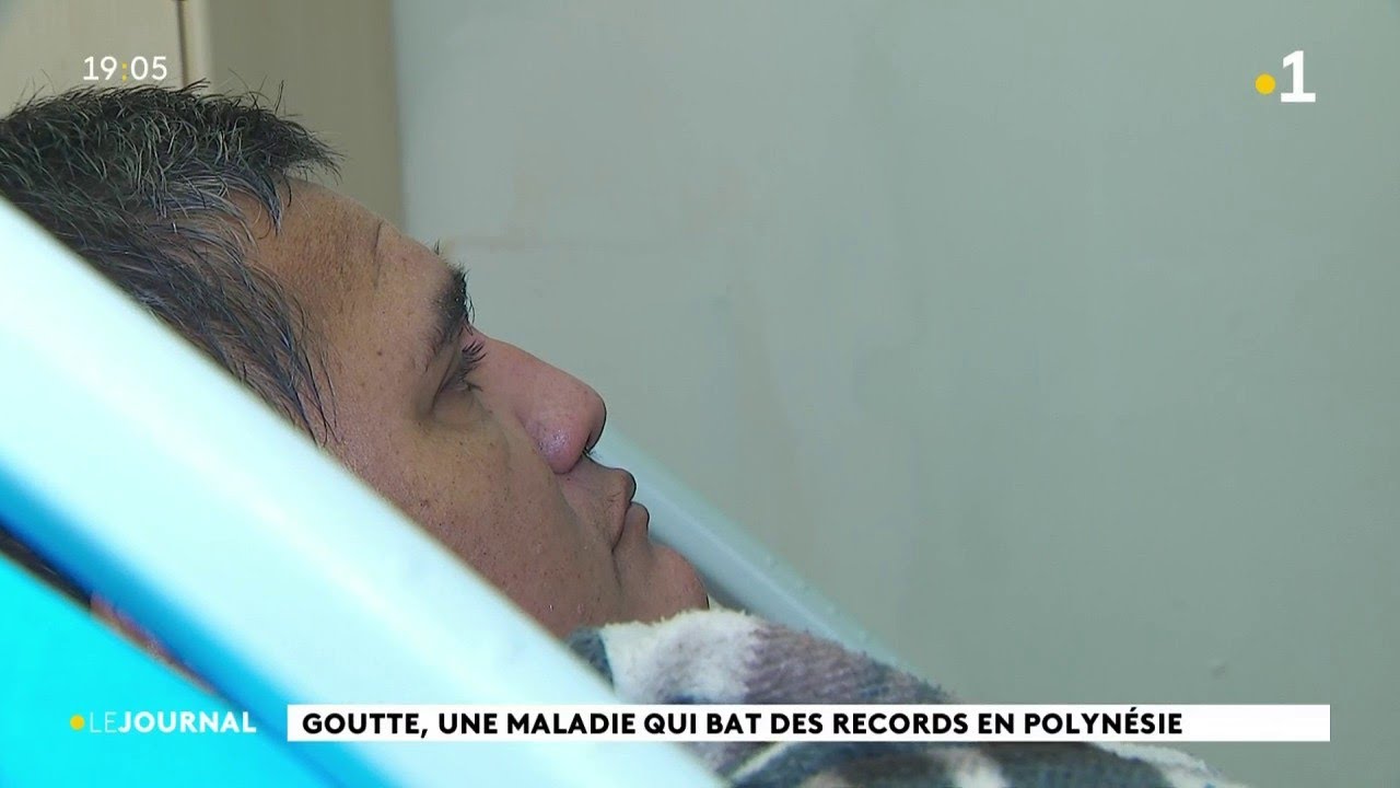 Pr&egrave;s d'un quart des Polyn&eacute;siens ont la goutte
