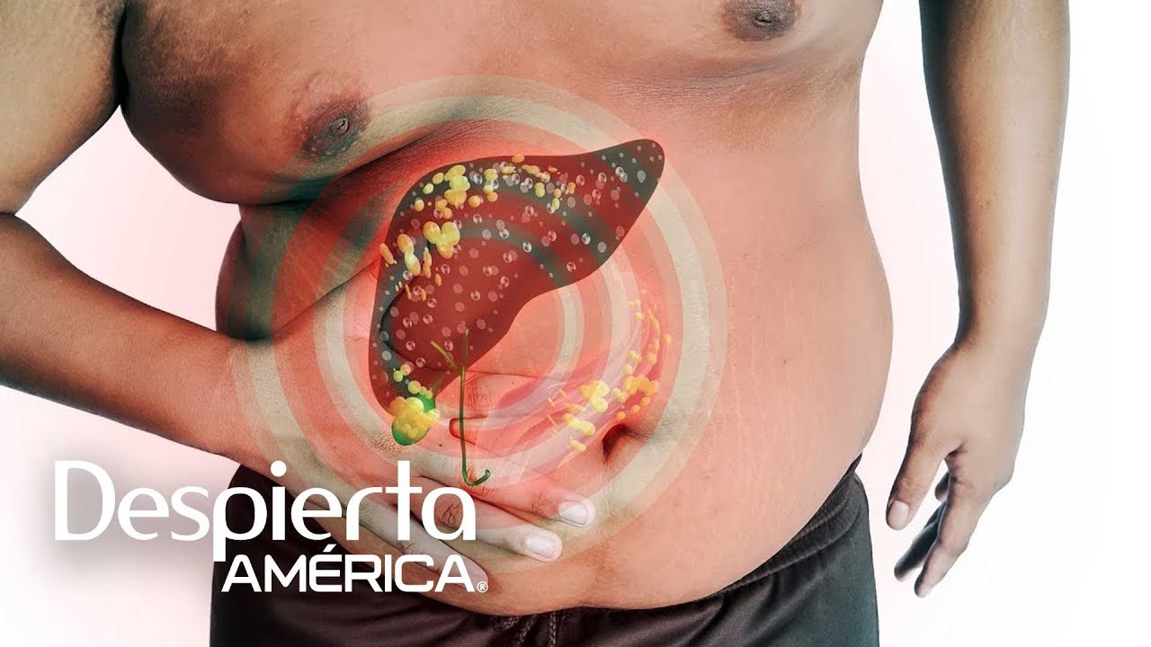 Qu&eacute; tomar para limpiar el h&iacute;gado graso (y otras dudas de salud) | Dr. Juan