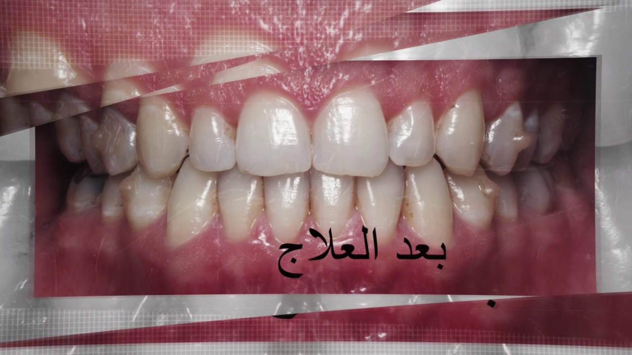 تعديل الاسنان بواسطة التقويم الامريكي الشفاف