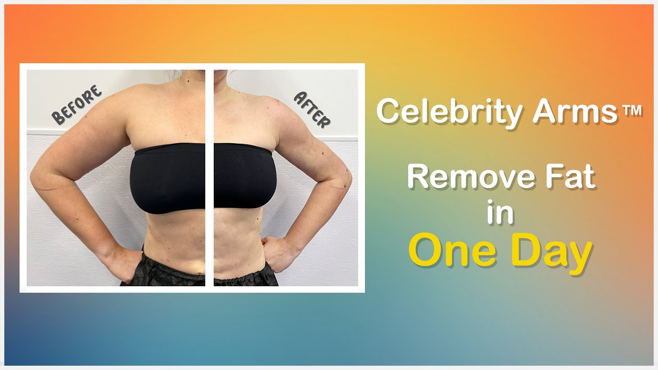 Celebrity Arms&trade; Liposuction | Lipo 360&deg; Arms | High-Definition | Expert Dr. Thomas Su