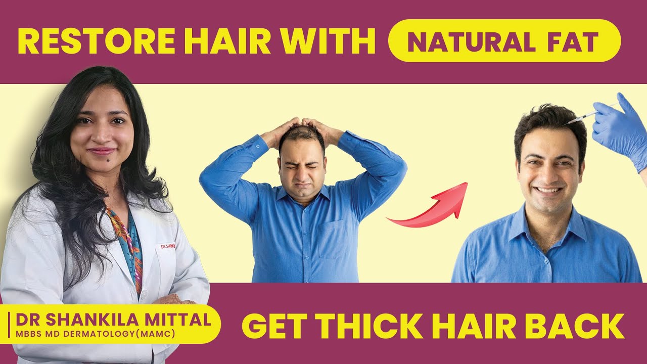 Nanofat Grafting for Hair Fall: Stem Cell Therapy Explained by Dermatologist