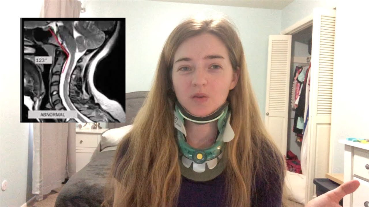 Diagnostic Testing for Craniocervical Instability (CCI) and Atlantoaxial Instability (AAI)