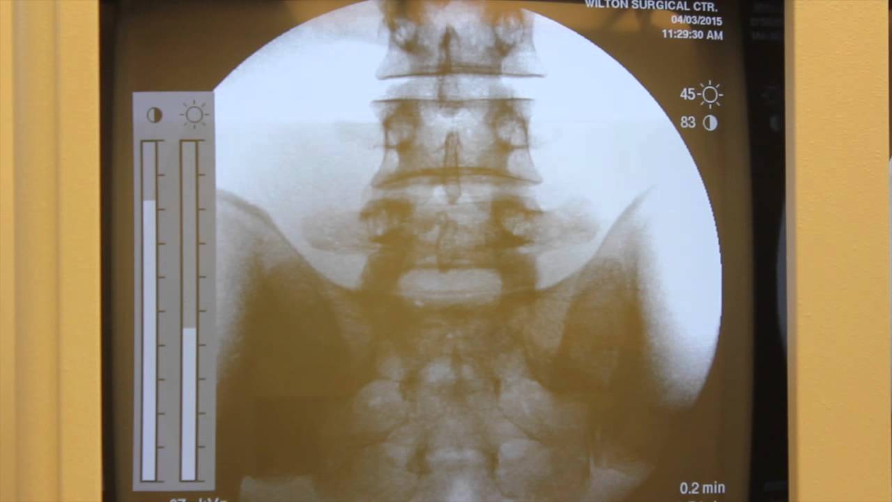 XRayBob C-Arm Overview and Scatter Radiation