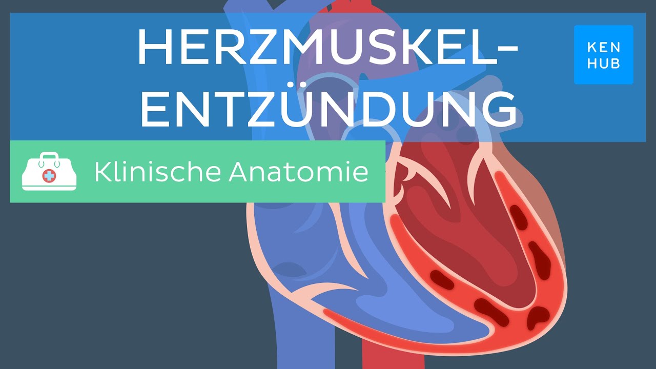 Herzmuskelentzündung: Ursachen, Symptome, Behandlung | Kenhub