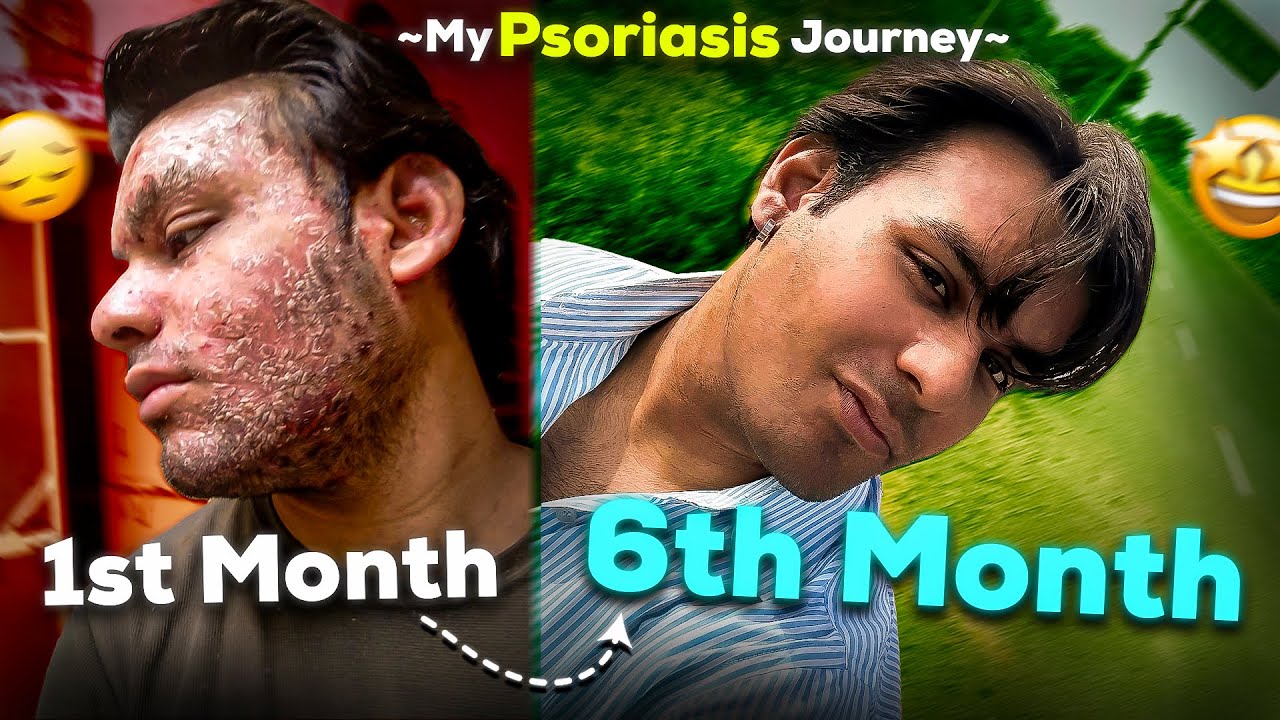 How to Treat Psoriasis in 6 Months ~ Psoriasis Treatment, Doctor, diet & everything! (Full Guide)