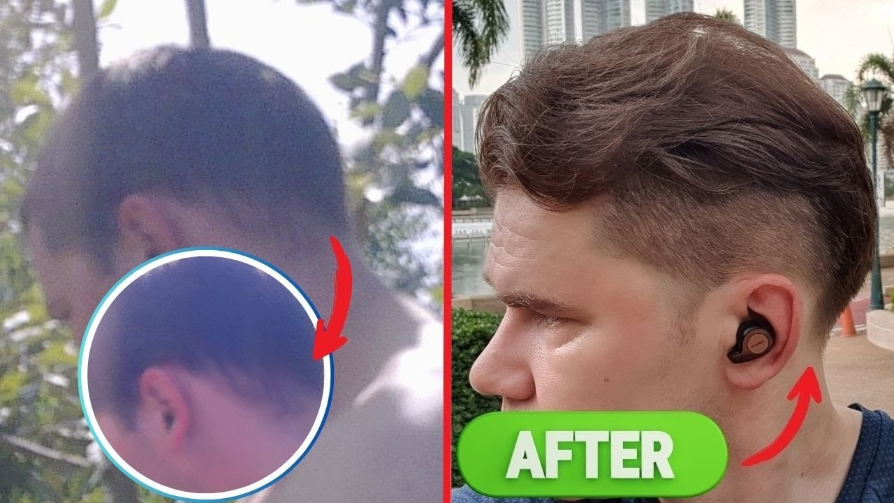 I Reversed Retrograde Alopecia – See My Real Regrowth Before & After