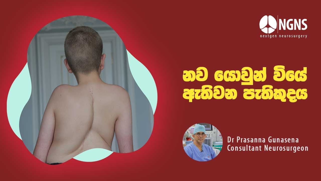 නව යොවුන් වියේ ඇතිවන පැතිකුදය  | juvenile idiopathic scoliosis