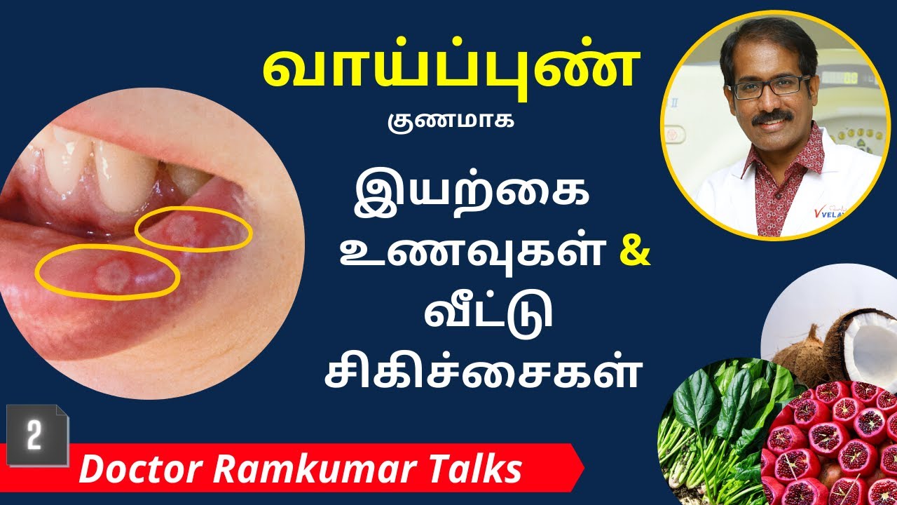 வாய்ப்புண் ஆற, குணமாக இயற்கை உணவுகள் & வீட்டு சிகிச்சை | Home Remedies for Mouth Aphthous Ulcer