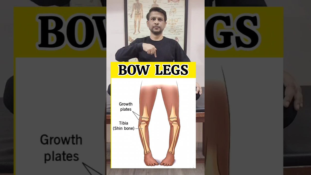 Bow Legs correction Exercise #shorts #tranding