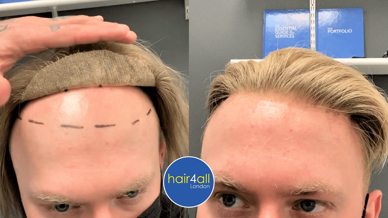 The Best Natural Hair System Hair Line! Shocking Result! Non-Surgical Hair Replacement System Men UK