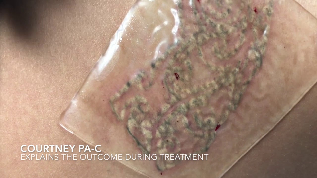 Laser Tattoo Removal with PFD Patch and Results!