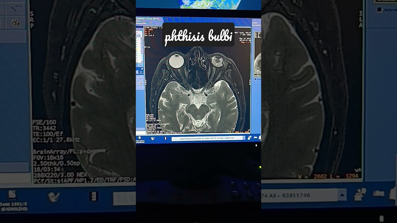 mri case phthisis bulbi Lt eye #mri  orbit contrast