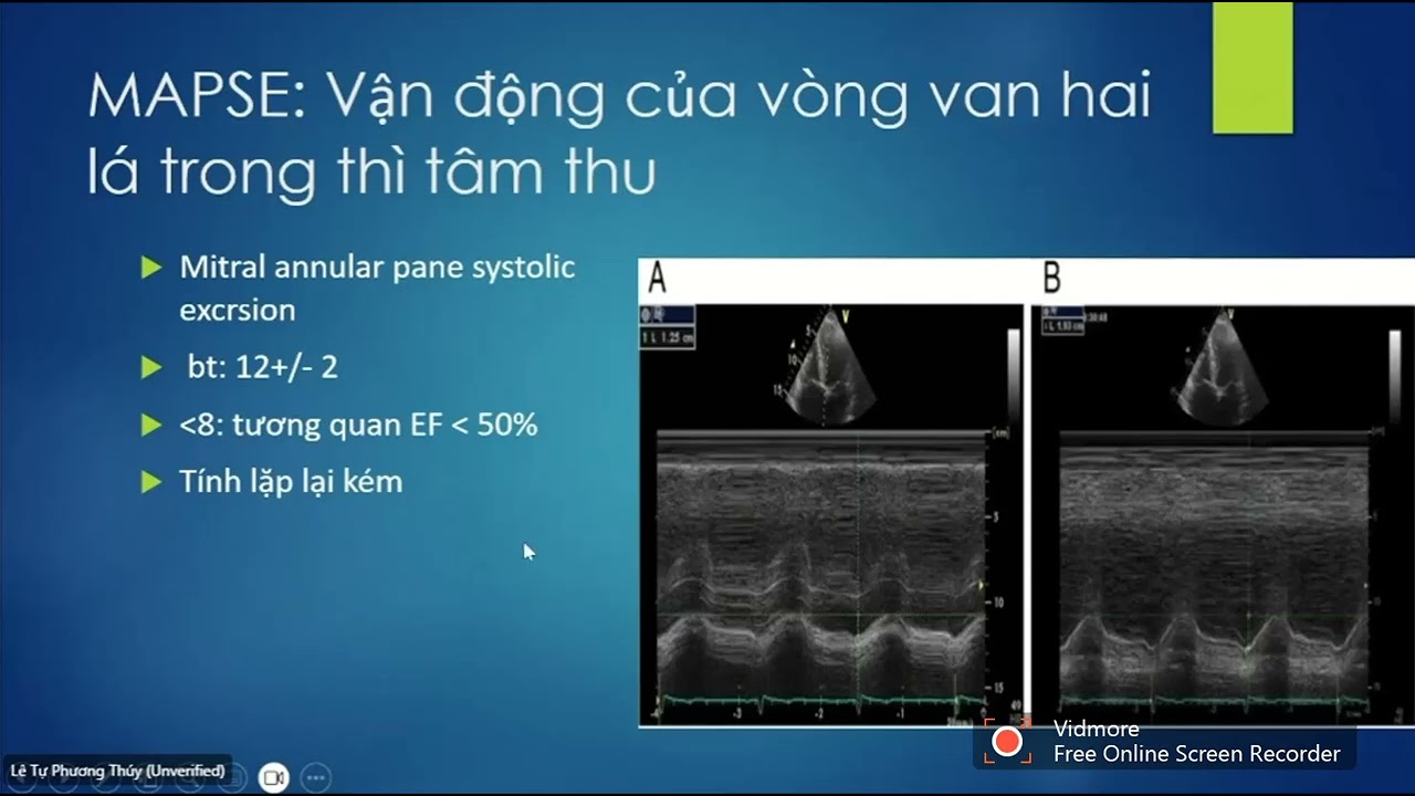 SIÊU ÂM ĐÁNH GIÁ CHỨC NĂNG TÂM THU THẤT TRÁI| ThS. BSCKII. Lê Tự Phương Thúy