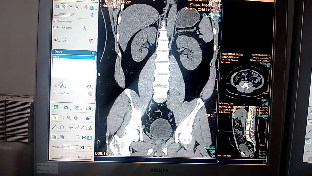 Cara Trecing CT Scan Urografi