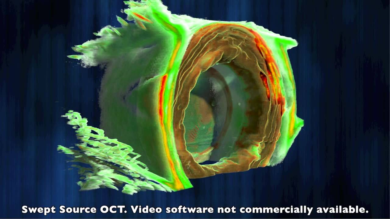 Swept Source OCT Anterior Chamber of the eye
