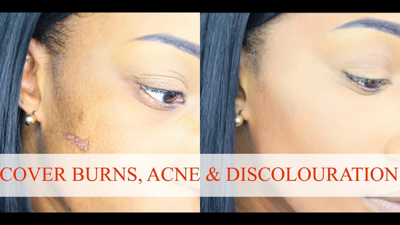 HOW TO COVER BURNS, SCARS & ACNE | COLOUR CORRECT | IAMSHE