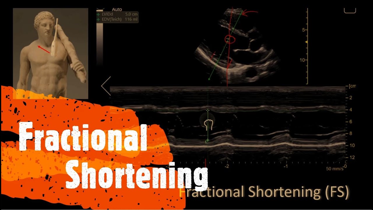 Fractional Shortening. Perioperative & Critical Care ECHO / POCUS