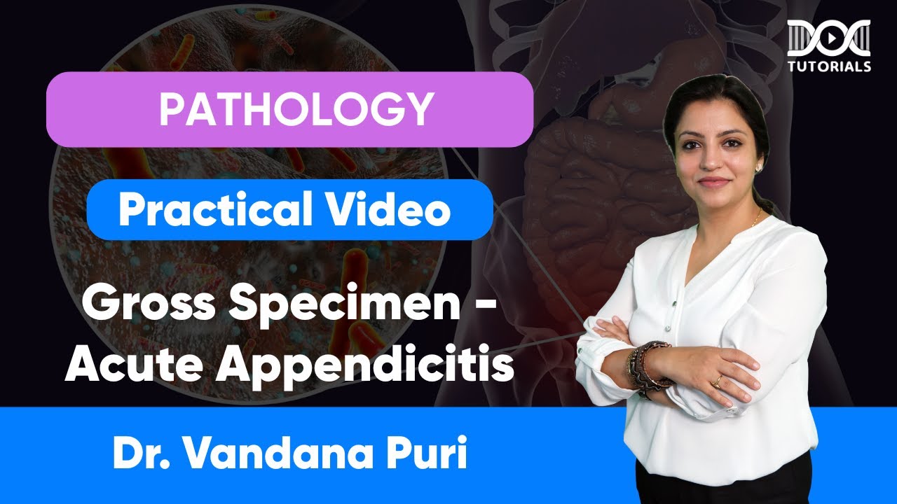 Gross Specimen &ndash; Acute Appendicitis | Pathology Practical | Dr. Vandana Puri | DocTutorials MBBS