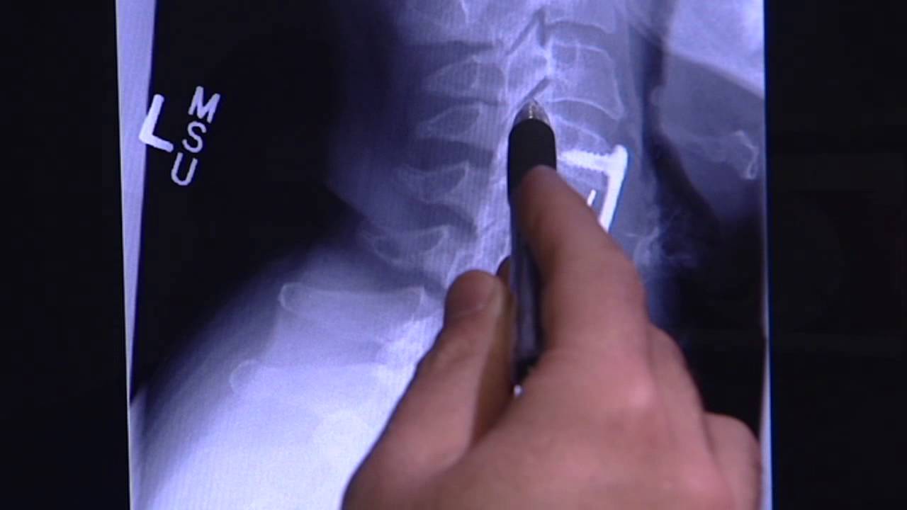 Radiofrequency Ablation for Spine Pain with Dr. Steven Barna - Florida Orthopaedic Institute