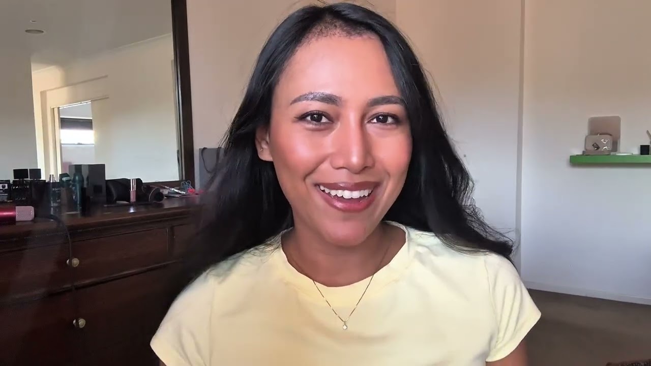 1 Month After Hair Transplant Surgery | Cosmedica Update @cosmedicaclinic 