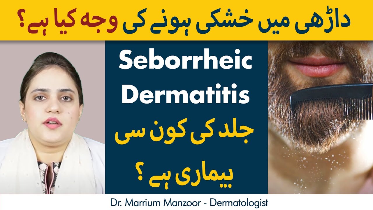 Dandruff in Beard | Seborrheic Dermatitis Konsi Bemari hai? | Treatment of Seborrheic Dermatitis