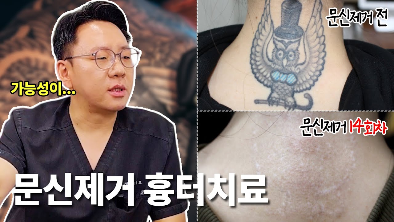 같은 문신 제거인데 흉터 차이가 나는 이유?