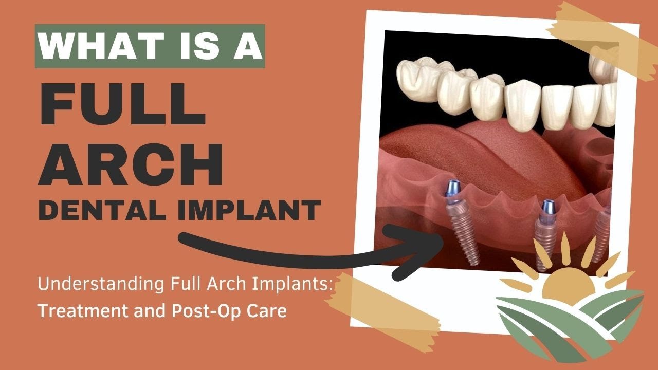 Full Arch Dental Implants to Replace Dentures with Post Treatment Care and Instructions