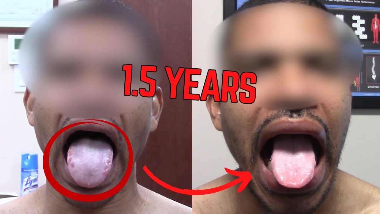 Swollen Tongue for 1.5 Years &mdash; Watch the Difference After This