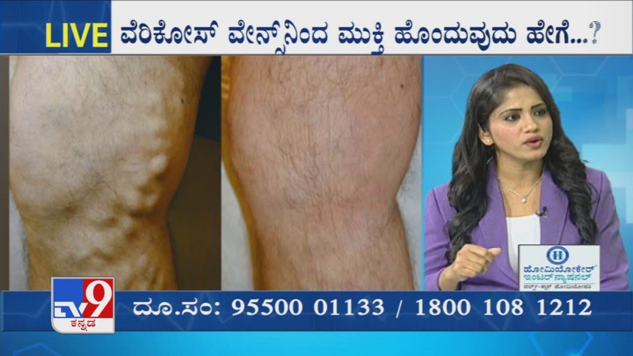 Nimma Doctor | Homeopathic Treatment For Varicose Veins | Homeocare International