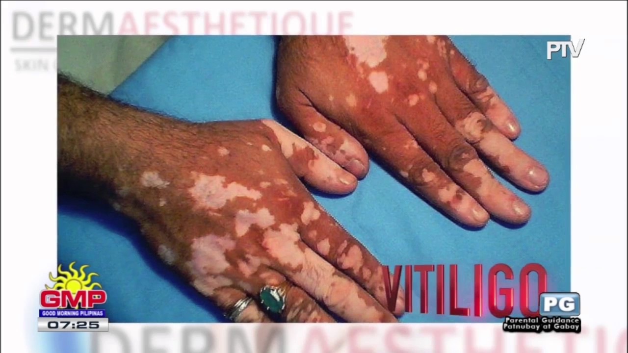 DERMAESTHETIQUE: Vitiligo