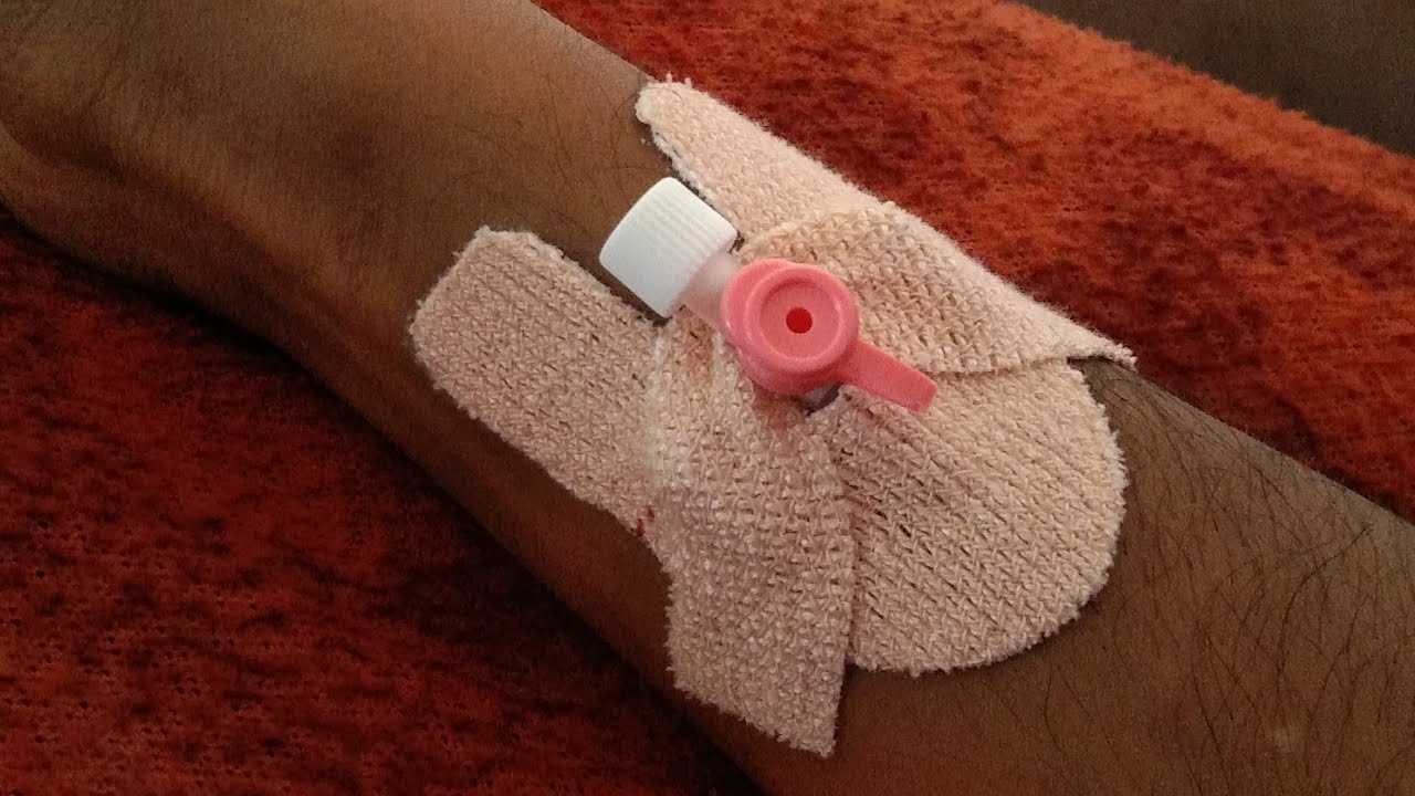 Guess the Number Of Iv  cannula