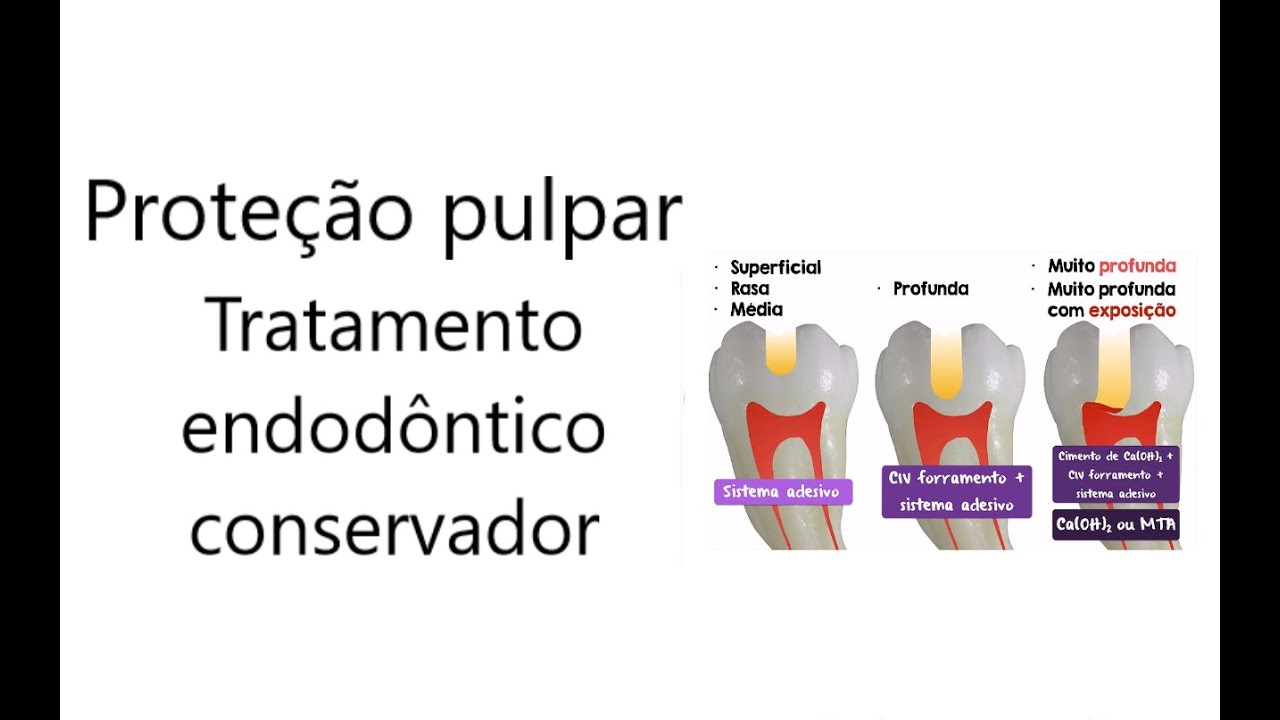 Prote&ccedil;&atilde;o pulpar - Tratamento endod&ocirc;ntico conservador (odontopediatria)
