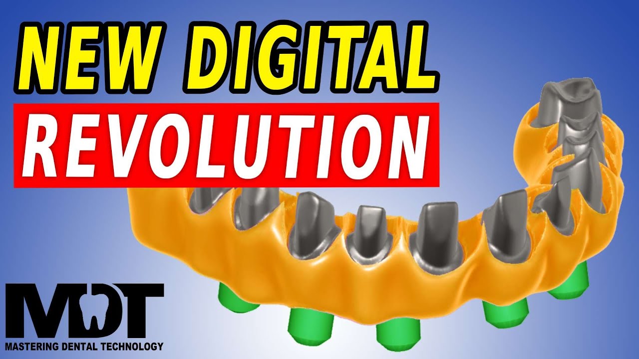 NEW ALL ON 4 Digital Workflow Thimble Crowns & Optisplint [ Screw Retained All On X ]