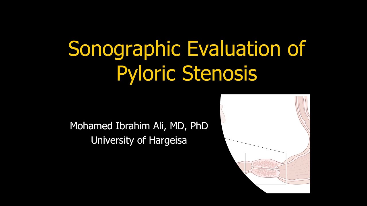 Sonographic Evaluation of Pyloric Stenois