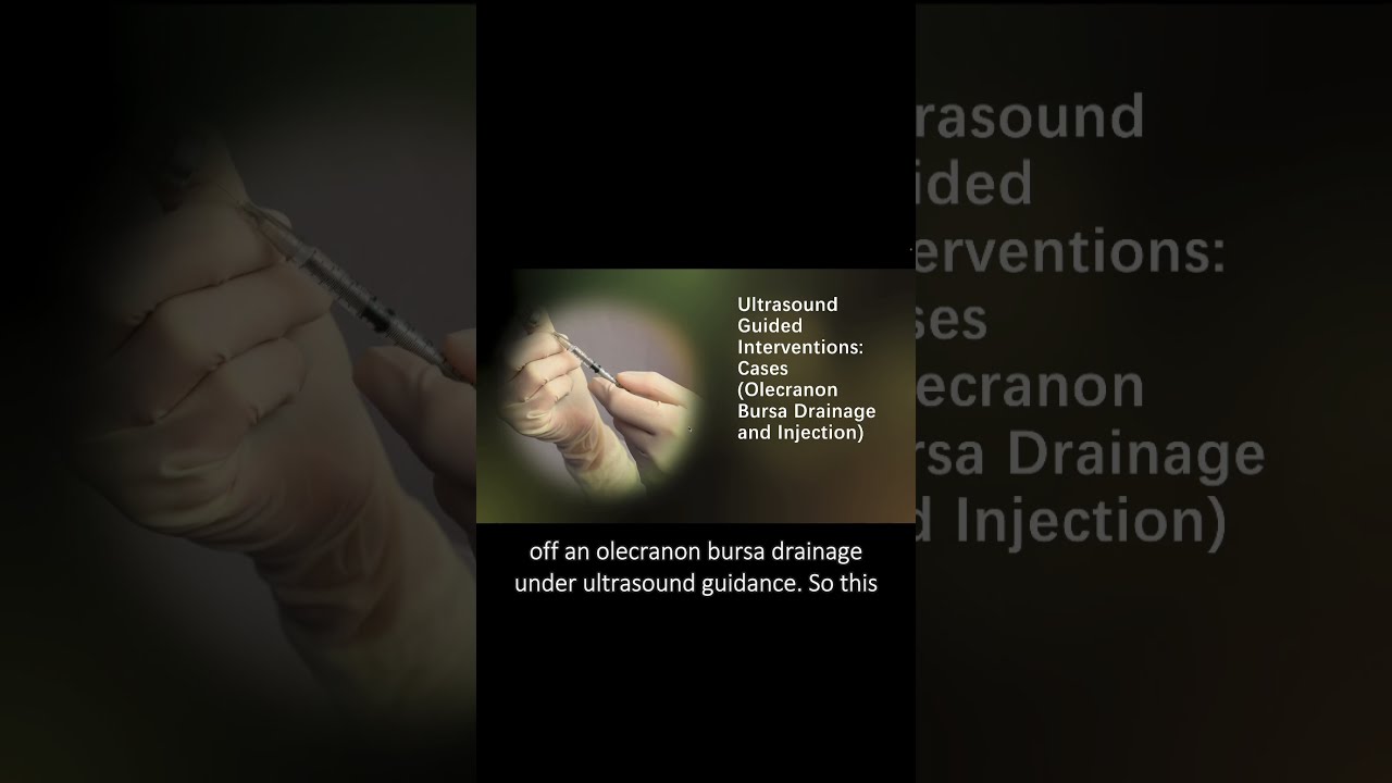 #ultrasound Guided Interventions: Cases (Olecranon Bursa Drainage and Injection)