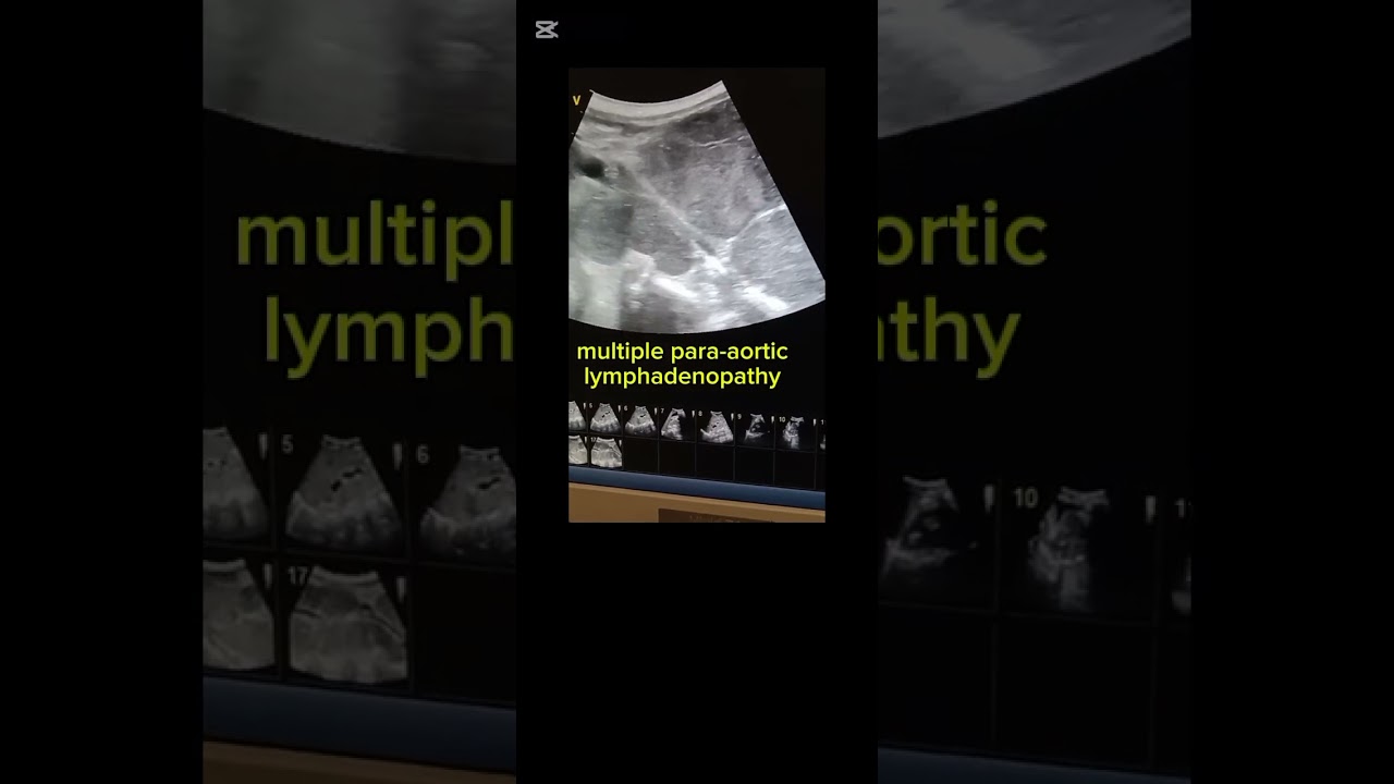 Multiple para-aortic lymphadenopathy