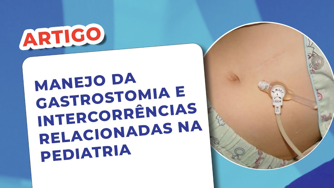 EP 124 - Manejo da gastrostomia e intercorrências relacionadas na pediatria - Artigo